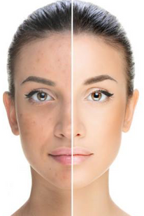 Peeling Behandlung Wien